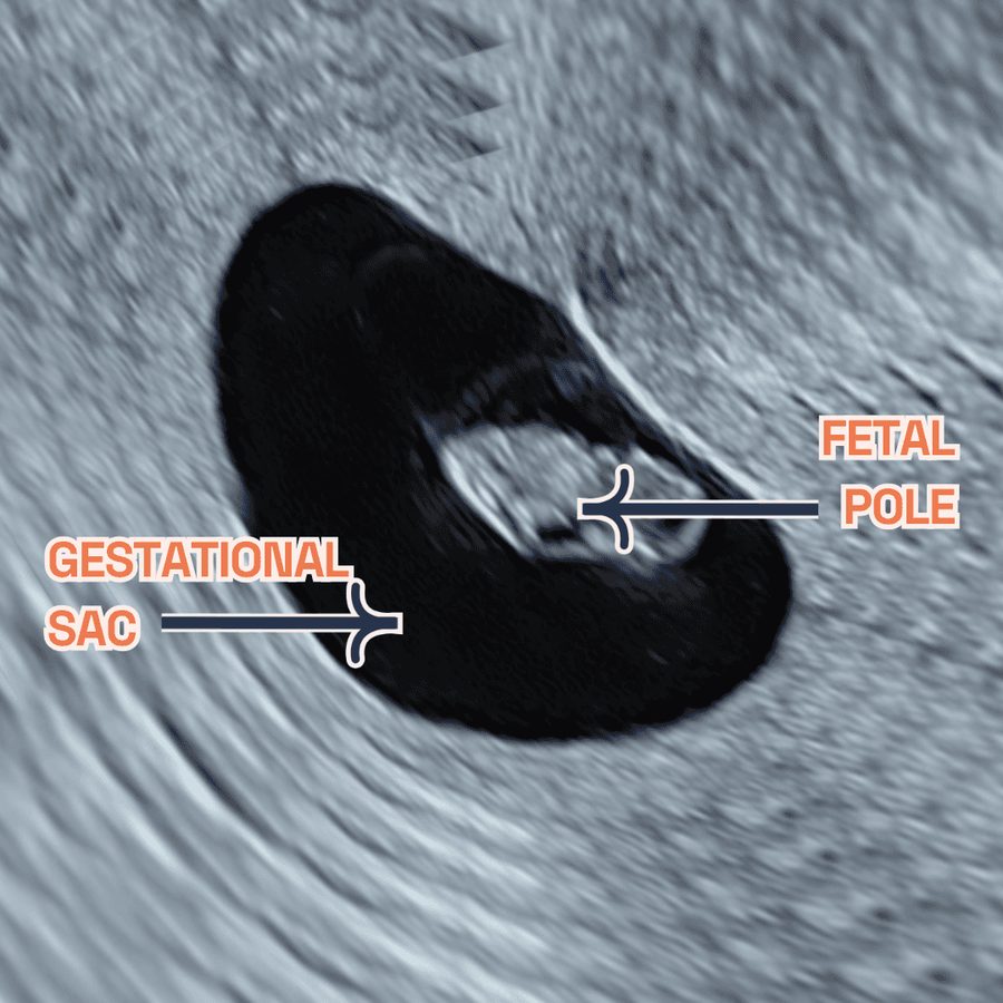 Ultrasound of an early pregnancy, marked to show the gestational sac and the fetal pole